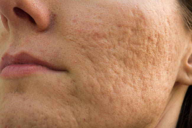 Skin Conditions | Hives | Acne | MedlinePlus